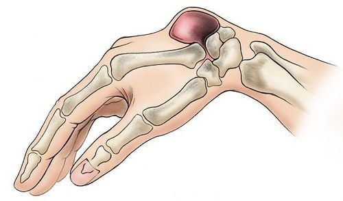 Triệu Chứng U Bao Hoạt Dịch và Các Phương Pháp Điều Trị An Toàn