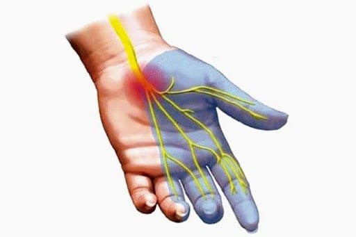 Hình ảnh minh họa hội chứng ống cổ tay chèn ép dây thần kinh