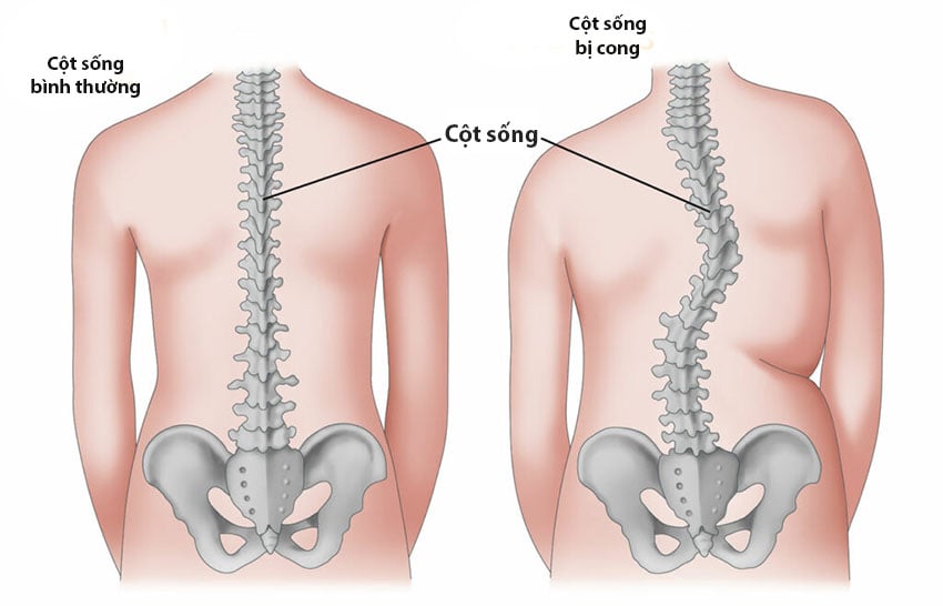 Hình minh họa thoát vị đĩa đệm cột sống thắt lưng