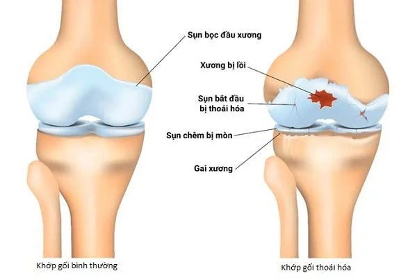 Hình so sánh khớp gối bình thường và khớp gối bị thoái hóa – sụn khớp bào mòn, gai xương và viêm khớp gây đau, cứng khớp.