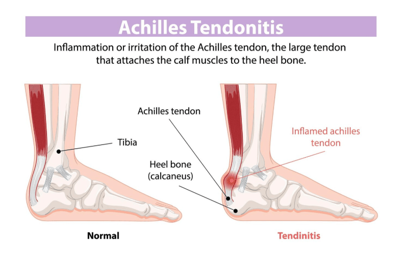 Viêm Gân Gót Chân Achilles – “Căng” Một Chút Cũng Đau: Đừng Xem Nhẹ!