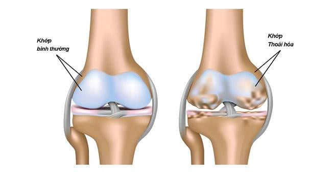 Thoái Hoá Khớp Gối: Nguyên Nhân, Dấu Hiệu Sớm Và Cách Điều Trị Hiệu Quả