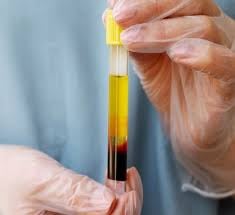 HUYẾT TƯƠNG GI&Agrave;U TIỂU CẦU (PRP) TRONG TRẺ H&Oacute;A DA