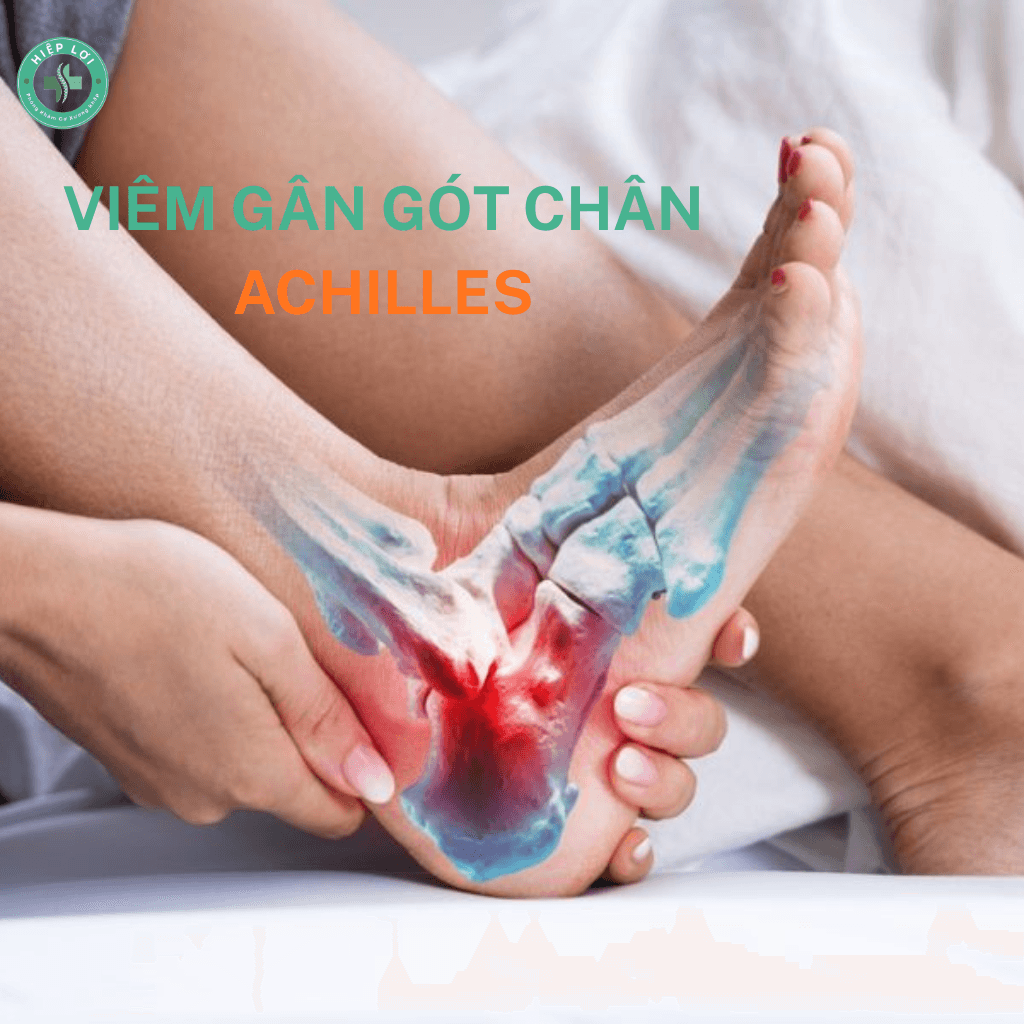 Viêm Gân Gót Chân Achilles: Hiểu Đúng Để Điều Trị Dứt Điểm, Ngừa Biến Chứng