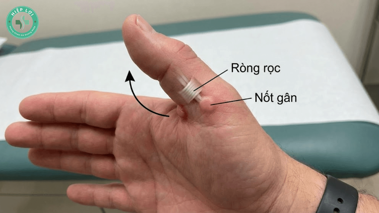 Ngón Tay Lò Xo (Viêm Bao Gân Gấp): Dấu Hiệu, Nguyên Nhân & Cách Điều Trị Tại Tân Phú