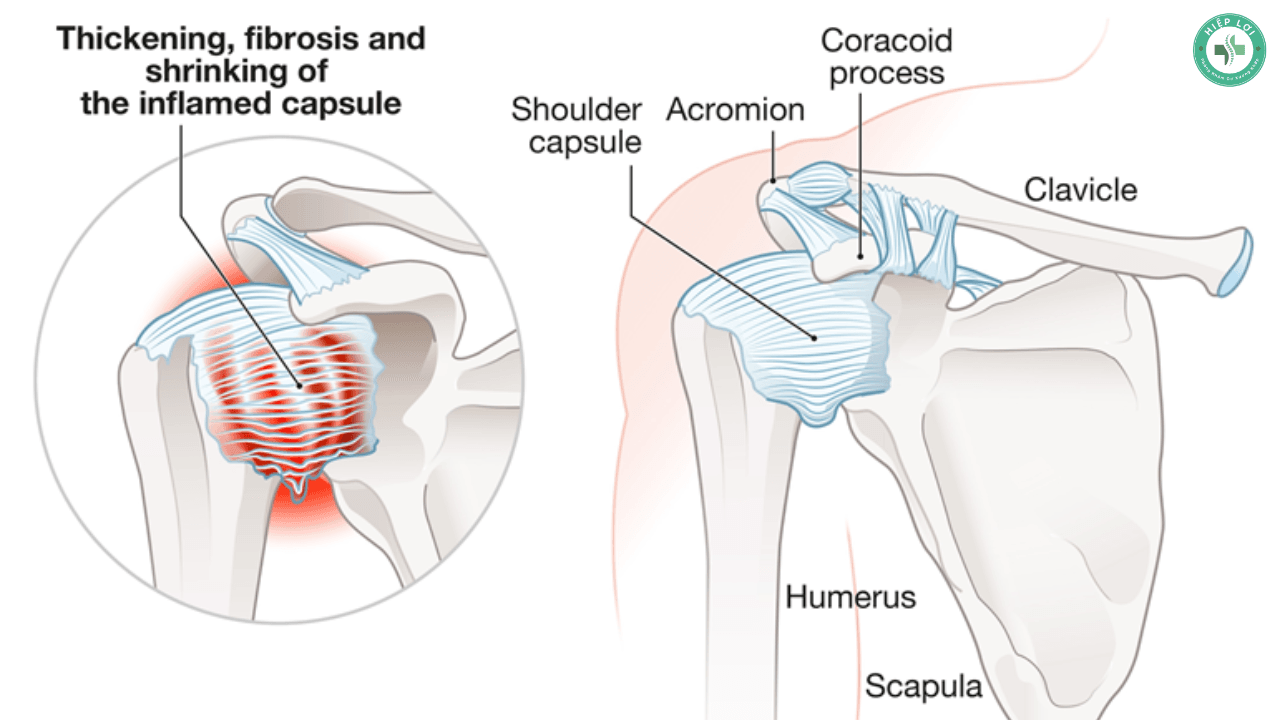 Viêm Quanh Khớp Vai: 3 Giai Đoạn Bệnh & Cách Chữa Trị