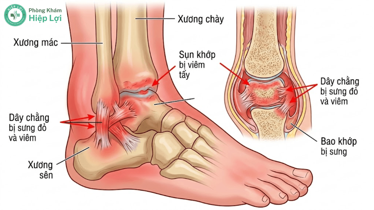 Viêm Khớp Cổ Chân: Cảnh Báo Dấu Hiệu Sụn Bị Bào Mòn & Phác Đồ Phục Hồi Không Phẫu Thuật