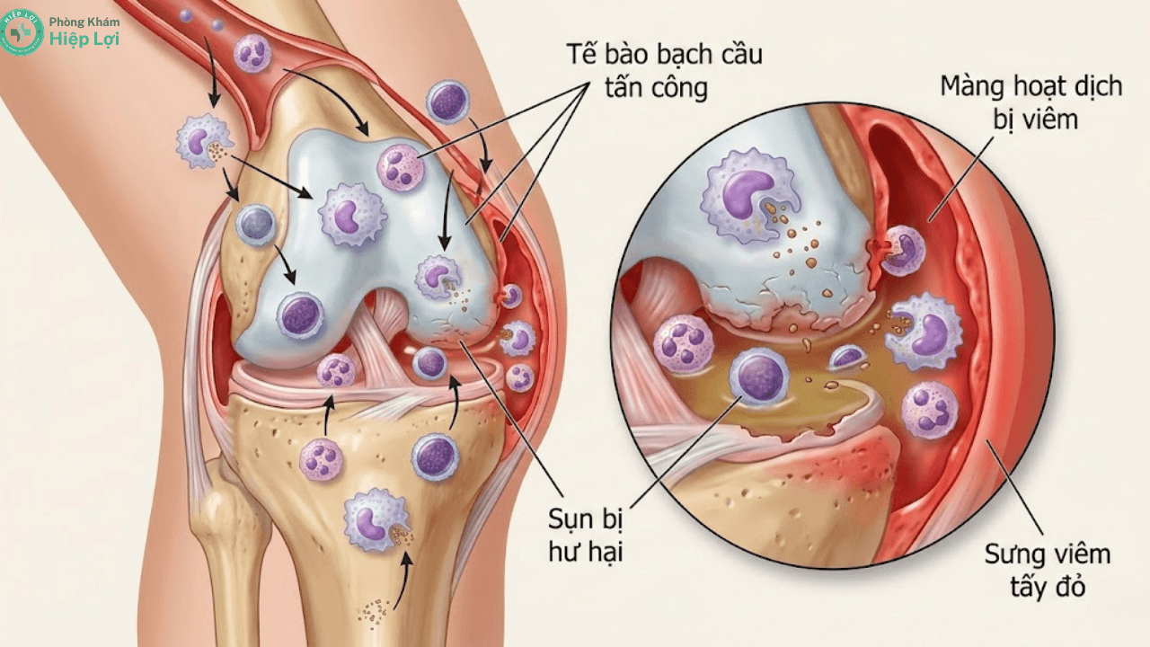 Viêm Khớp Tự Miễn: Dấu Hiệu Nhận Biết Sớm & Phác Đồ Kiểm Soát Biến Dạng Khớp