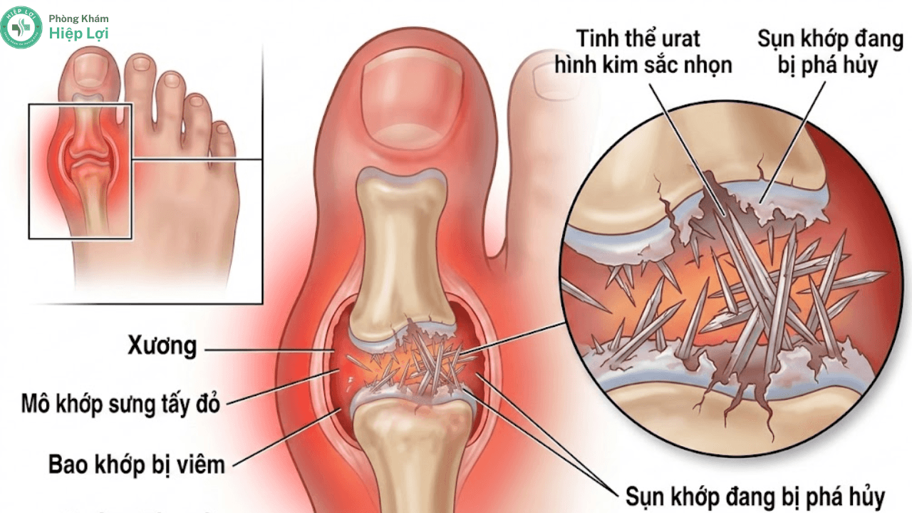 Khám Bệnh Gout Ở Đâu Tốt Tại Tân Phú? Vì Sao Phải Điều Trị Sớm Để Tránh Biến Chứng?