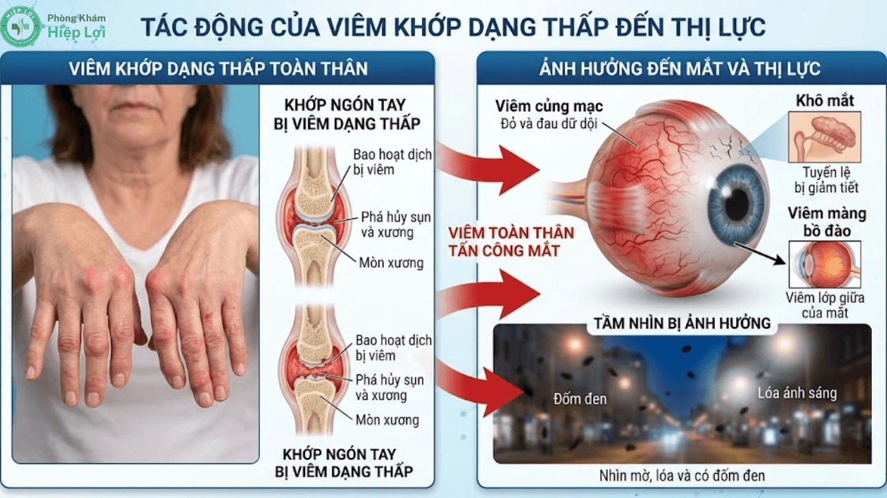 Viêm Khớp Dạng Thấp Ảnh Hưởng Đến Thị Lực Như Thế Nào? Dấu Hiệu & Cách Kiểm Soát
