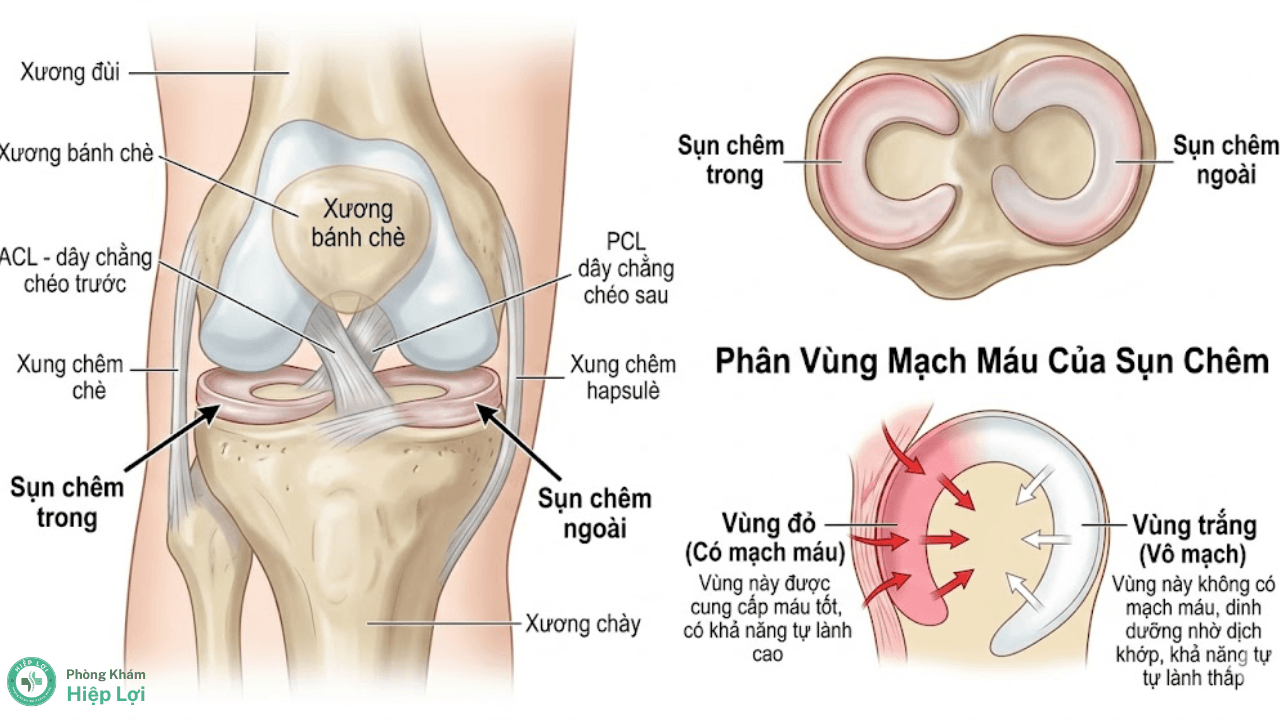 Rách Sụn Chêm Khớp Gối: Dấu Hiệu Kẹt Khớp & Phác Đồ Phục Hồi Chuyên Sâu