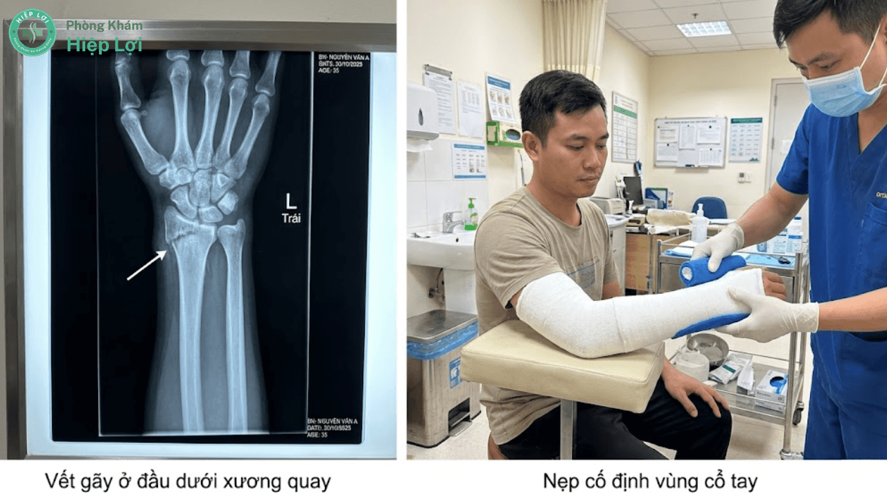 Gãy Xương Cổ Tay Bao Lâu Thì Lành? Phác Đồ Phục Hồi Chức Năng Nhanh Chóng