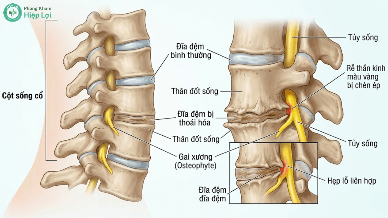 Triệu Chứng Thoái Hóa Đốt Sống Cổ: Dấu Hiệu Tê Tay, Chóng Mặt & Phác Đồ Trị Liệu