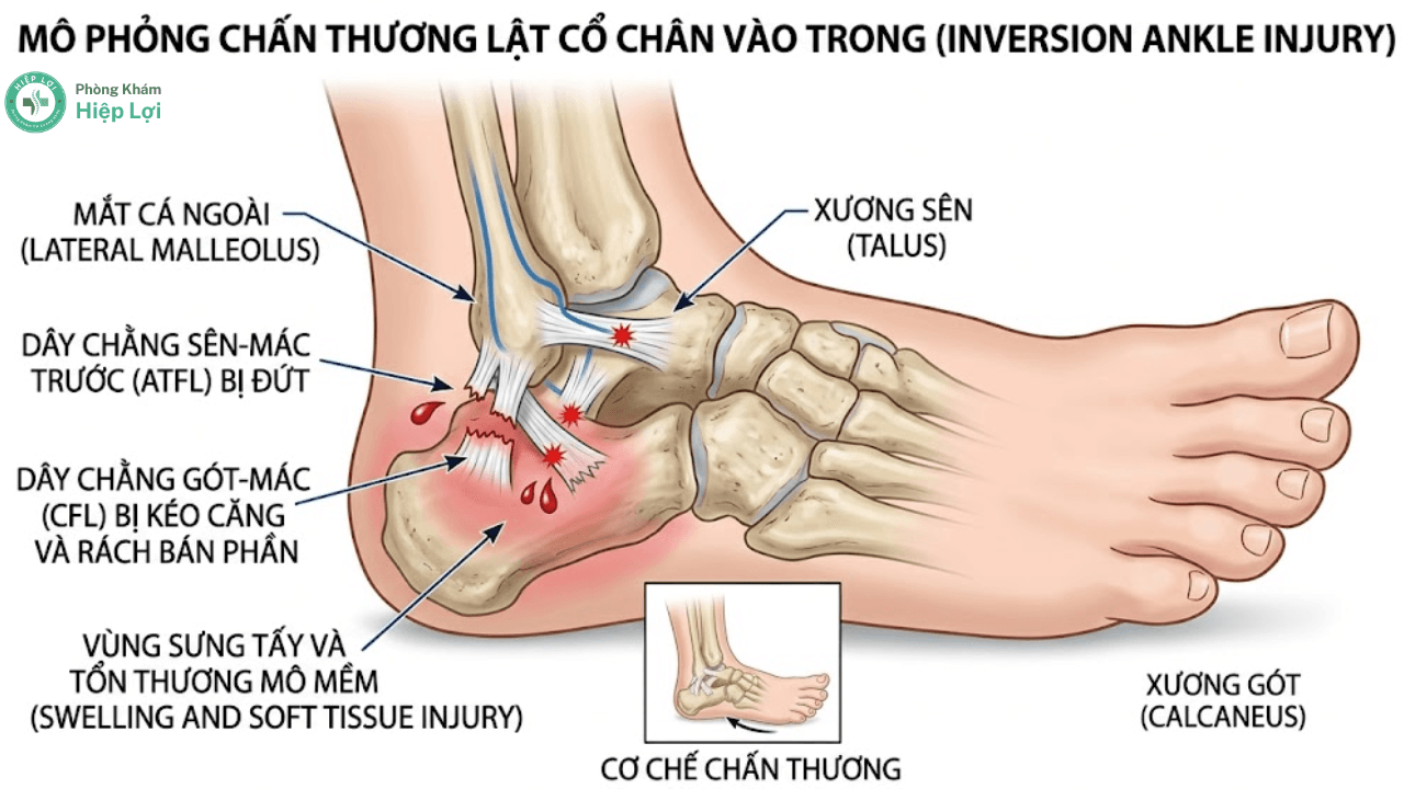 Cách Xử Lý Khi Bị Bong Gân Cổ Chân: Sơ Cứu Chuẩn Y Khoa & Tránh Di Chứng