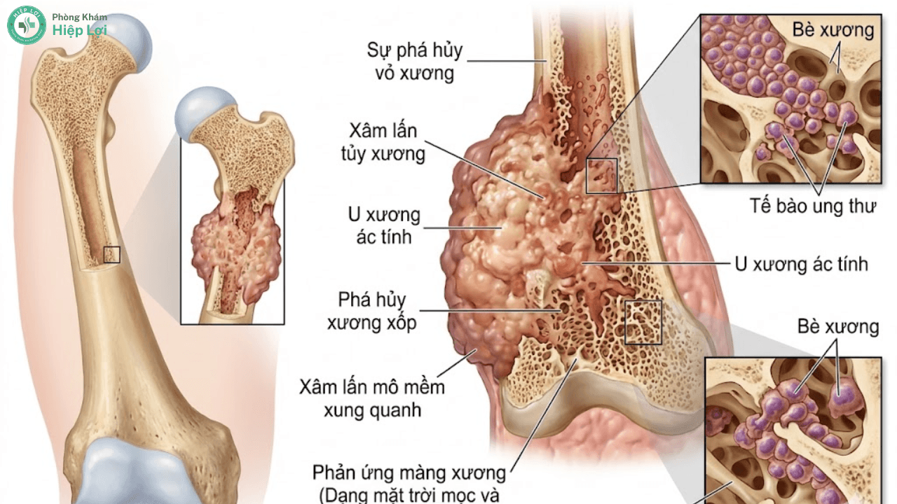 Ung Thư Xương: Dấu Hiệu Cảnh Báo Sớm & Phương Pháp Tầm Soát Chuẩn Xác