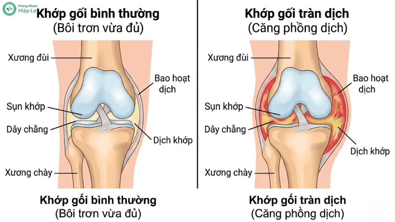 Tràn Dịch Khớp Gối: Dấu Hiệu Nhận Biết, Nguyên Nhân & Phác Đồ Điều Trị An Toàn