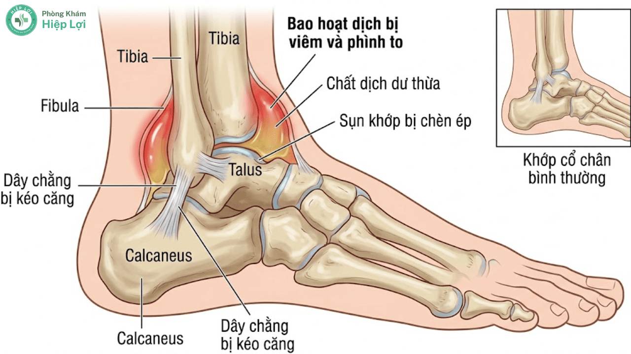 Tràn Dịch Khớp Cổ Chân: Dấu Hiệu Sưng Phù, Biến Chứng Và Cách Điều Trị