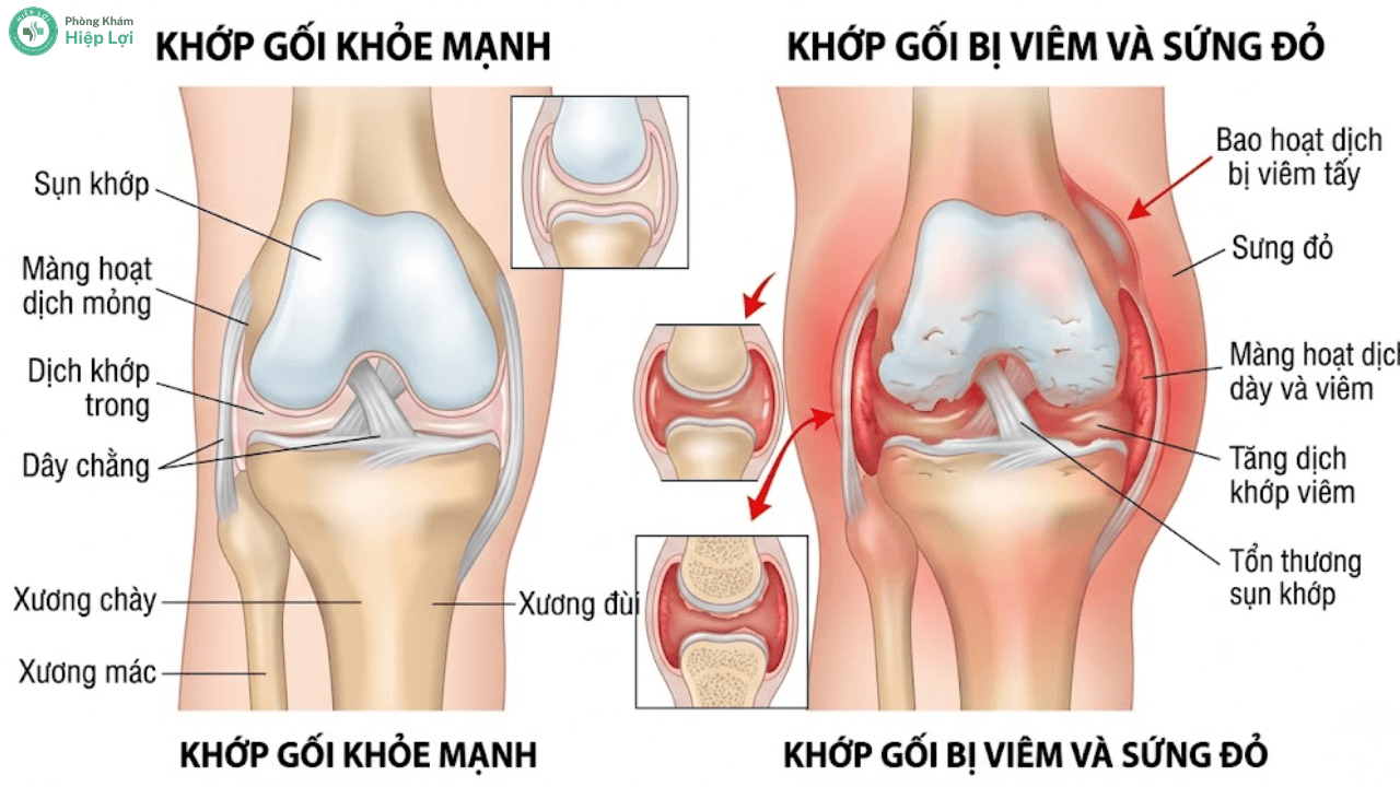 Các Triệu Chứng Viêm Khớp Thường Gặp: Dấu Hiệu Cảnh Báo Sớm Không Thể Bỏ Qua