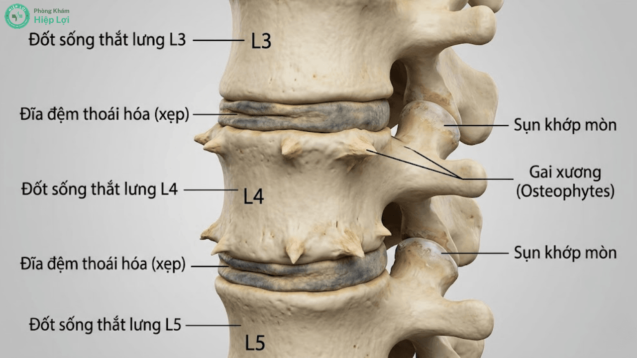 Thoái Hóa Cột Sống Thắt Lưng: Dấu Hiệu Đau Lưng Dưới & Phác Đồ Phục Hồi An Toàn