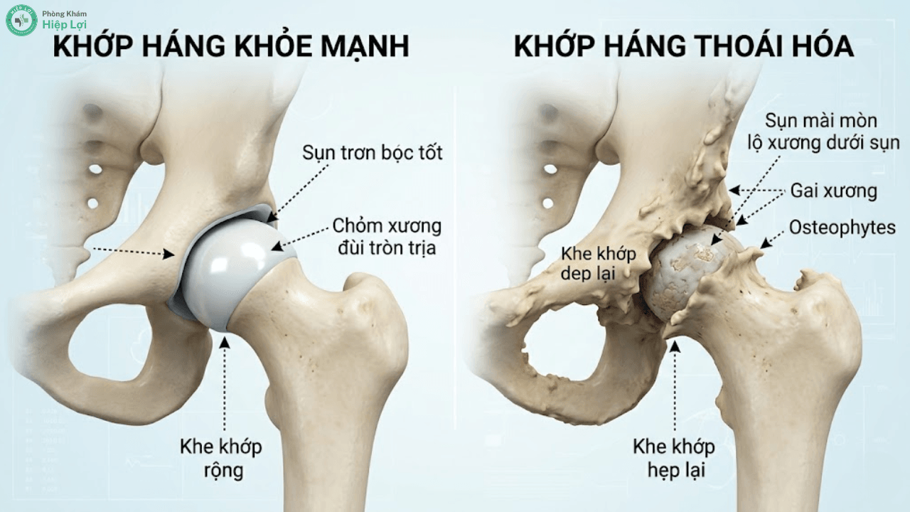 Thoái Hóa Khớp Háng: Dấu Hiệu Đau Vùng Bẹn, Nguyên Nhân & Phác Đồ Điều Trị