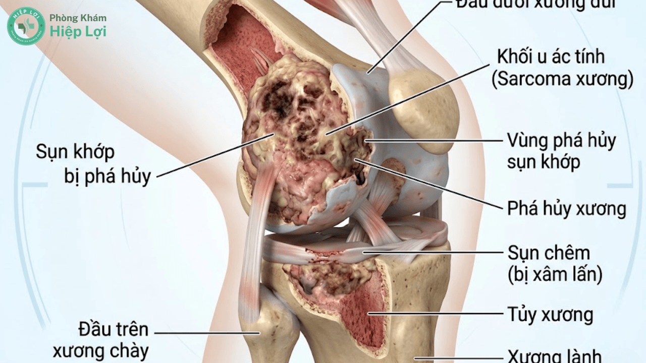 Ung Thư Xương: Dấu Hiệu Nhận Biết Sớm, Các Giai Đoạn & Phác Đồ Điều Trị