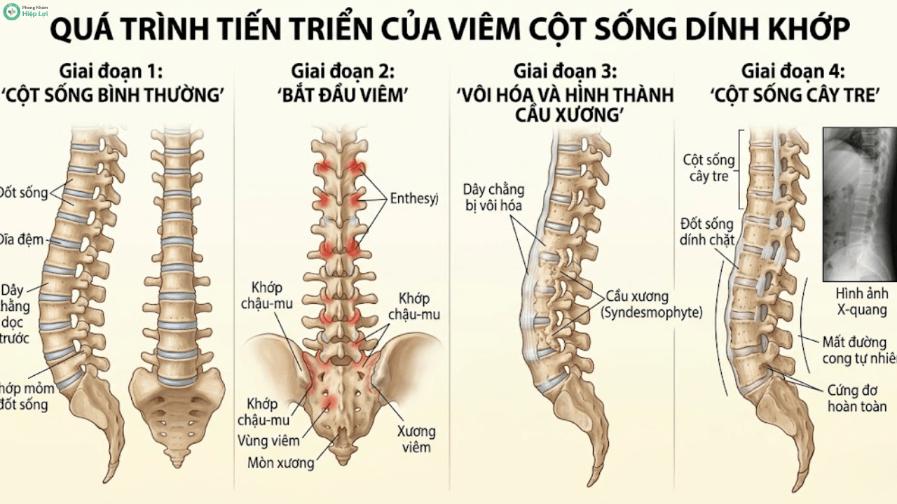 Viêm Cột Sống Dính Khớp Có Nguy Hiểm Không? Cảnh Báo Tàn Phế & Bài Tập Trị Liệu