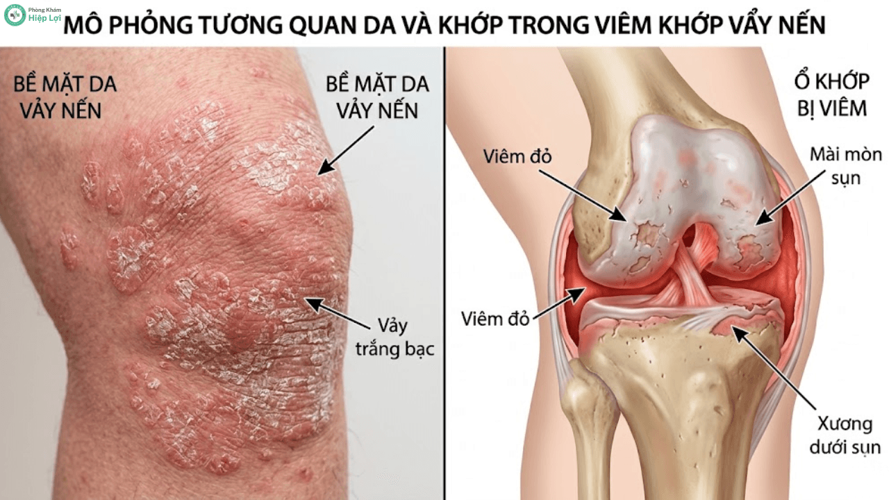 Viêm Khớp Vảy Nến: Dấu Hiệu Nhận Biết & Phác Đồ Điều Trị Sinh Học Tiên Tiến