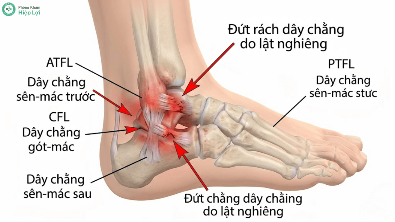 Bong Gân Chân: Dấu Hiệu, Cách Xử Lý & Phục Hồi