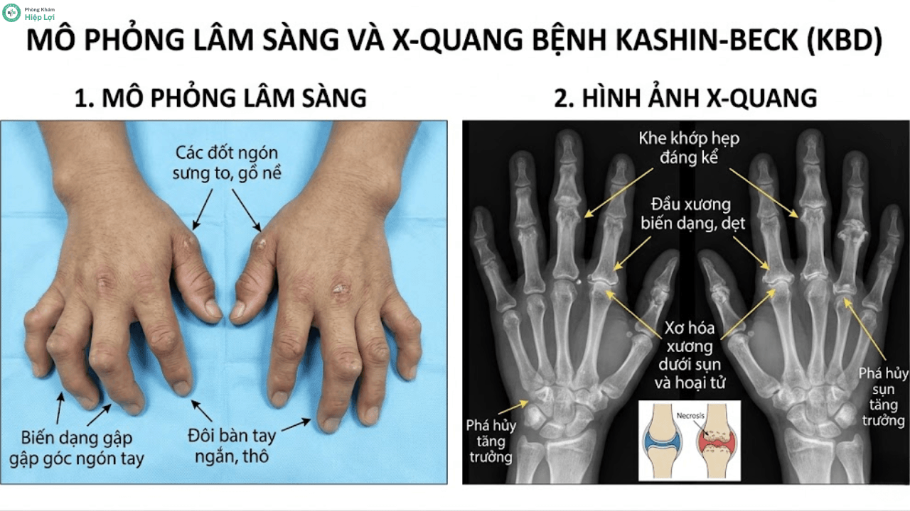 Bệnh Kashin-Beck (Bệnh To Khớp): Bí Ẩn Nguồn Gốc & Dấu Hiệu Cảnh Báo Sớm